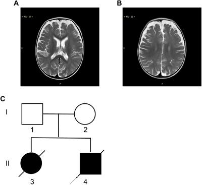 Compound Heterozygous CHAT Gene Mutations of a Large Deletion and a Missense Variant in a Chinese Patient With Severe Congenital Myasthenic Syndrome With Episodic Apnea